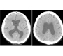 Holoprosencephaly in An Aged Man