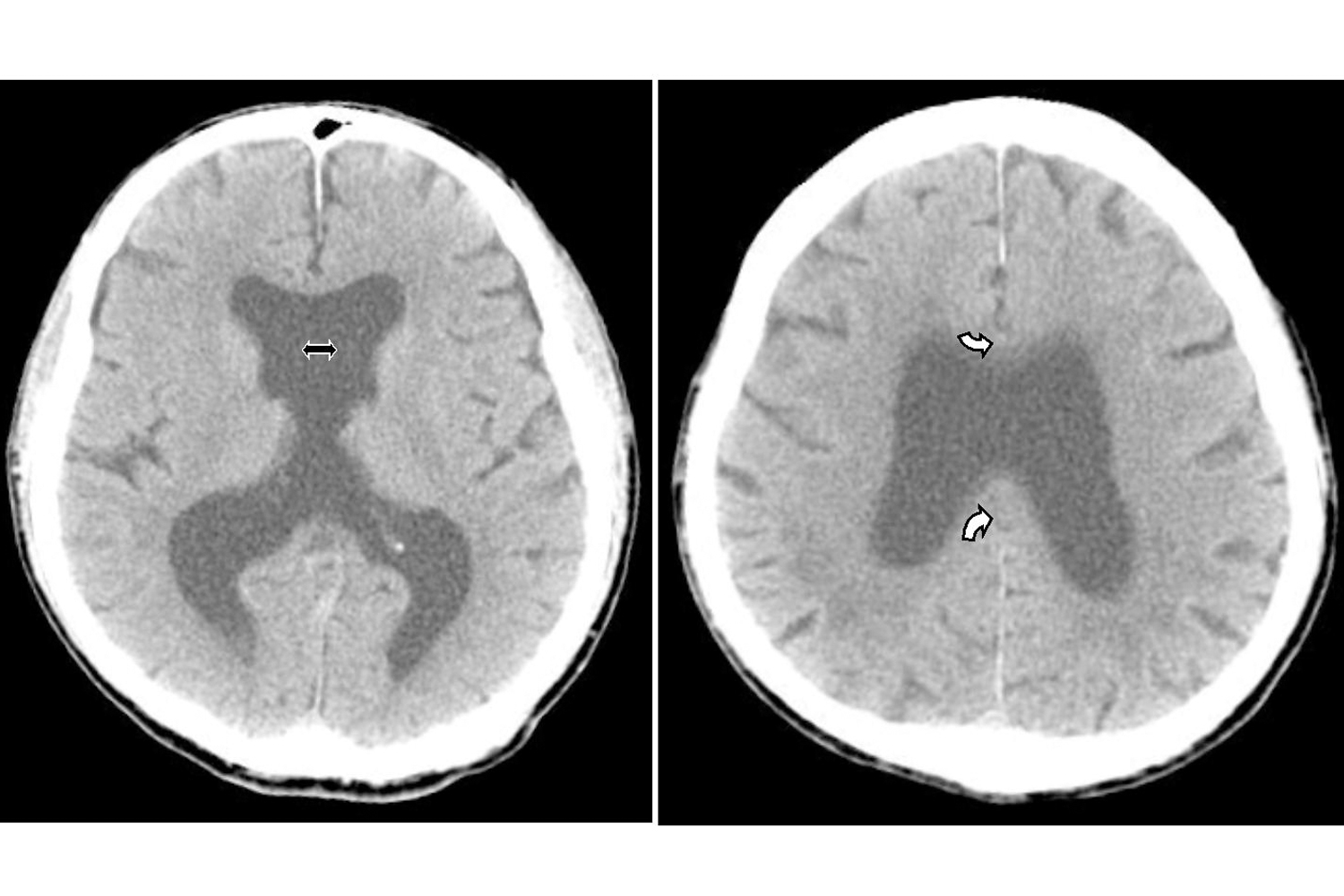 Holoprosencephaly in An Aged Man