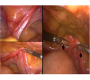 46, XY Disorder of Sex Development