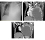 Cytic Presentation of Lung Adenocarcinoma: A Rare Entity