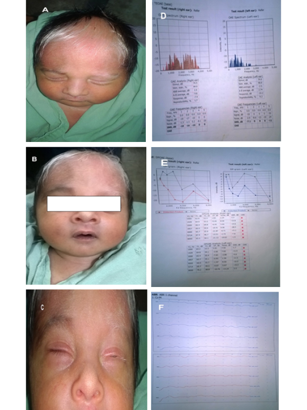 A Case of Waardenburg Syndrome Type 1