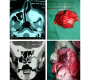 Maxillary Osteosarcoma with Fibrous Dysplasia of Frontal Bone - A Rare Case Blog