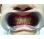 Dental Findings Associated with Hypoparathyroidism