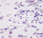 Concomitant Plasma Cell Tumor and Plasmodium Vivax Infection - Bone Marrow Aspiration