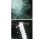 Impacted Foreign Body of Parapharyngeal Space a Rare Case Blog