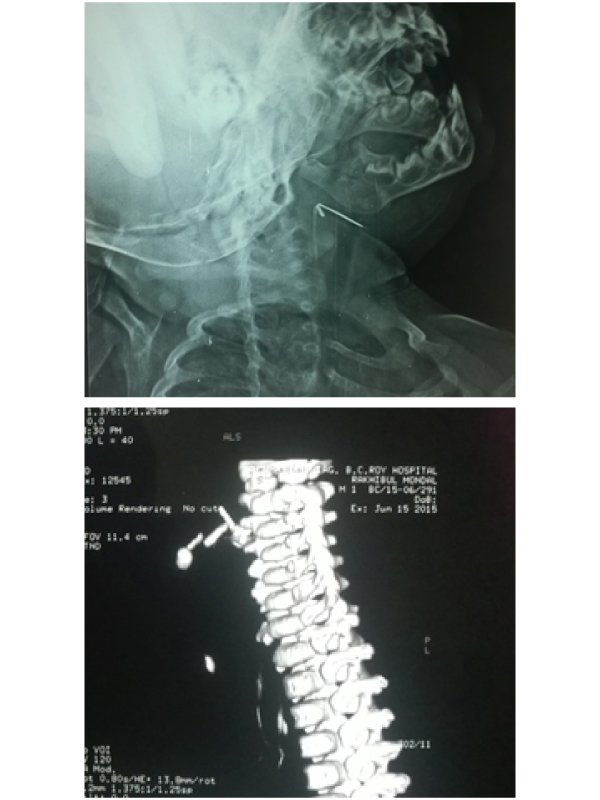 Impacted Foreign Body of Parapharyngeal Space a Rare Case Blog
