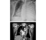 A Case of Lung Entrapment; Mesothelioma