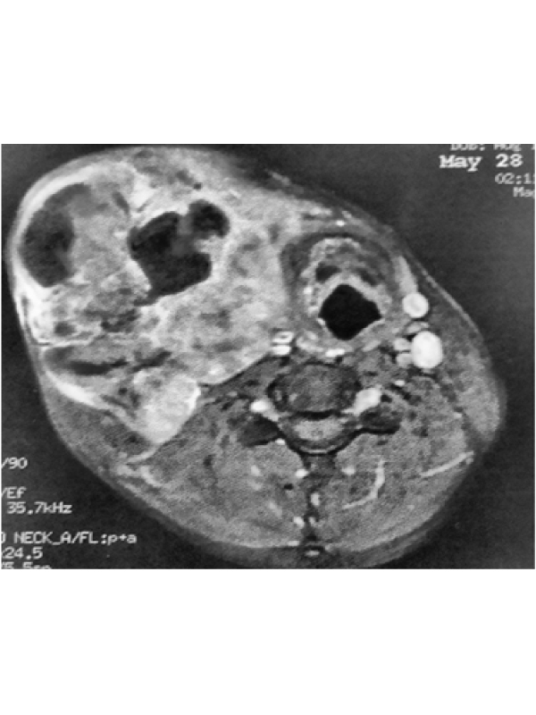Adenoid Cystic Carcinoma of Submandibular Gland: Case Report