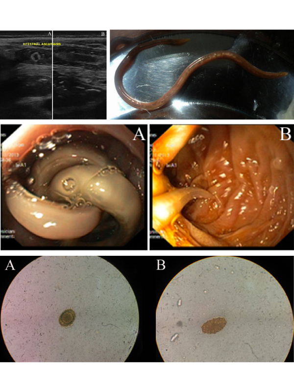 Ascaris lumbricoides - From Bedside to Benchside