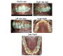 Retain Deciduous Teeth