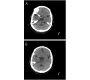 Hyperdense Basilar Artery Sign: An Indicator of Basilar Artery Thrombosis