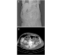 Abdominal Wall Necrotizing Fasciitis - A Hidden Presentation