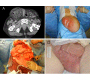 Surgical Intervention for Massive Inguino-Scrotal Herniae with an Obliterated Intra-Abdominal Cavity