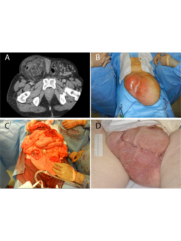 Surgical Intervention for Massive Inguino-Scrotal Herniae with an Obliterated Intra-Abdominal Cavity