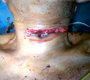 Suicidal Cut Throat Patient, Thyroid Cartilage Totally Injured