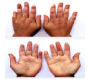 Raynaud's Phenomenon