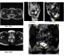Overt Mismatch between Clinical and Imaging Findings in Pelvic Organ Prolapse (POP): Case Blog