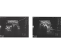 Metallic Wires-like Thyroid Calcifications