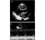 Left Atrial Myxoma - An Unusual Cause of Dyspnoea