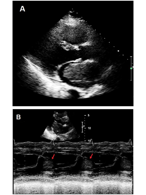 Left Atrial Myxoma - An Unusual Cause of Dyspnoea