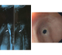 Esophageal Web in a Child