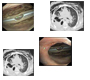 Rheumatoid Arthritis under Corticosteroid Therapy