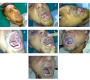 Behcet Disease