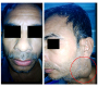 Schwannoma of the Para Pharyngeal Space