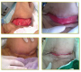 Matrix Therapy by Regenerating Agents (RGTA) in a Diabetic Patient with Necrotizing Fasciiti