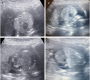 Congenital High Airway Obstruction Syndrome (CHAOS) ï¿½ A Rare Fetal Malformation Diagnosed on Antenatal Ultrasonography