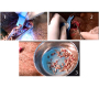 Management of Tracheostomy Site Myiasis