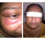 Skin Rashes in Systemic Lupus Erythematosus