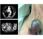 Lymph-node Metastasis in Advanced Papillary Thyroid Cancer