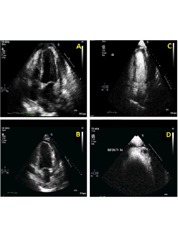 The Use of Contrast Echocardiography to Identify Infiltrating Lymphoma in the Myocardium