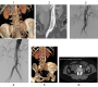 Endovascular Treatment of Focally Dissected Infrarenal Abdominal Aorta with Self-expandable Closed Cell Design Bare Metal Stents
