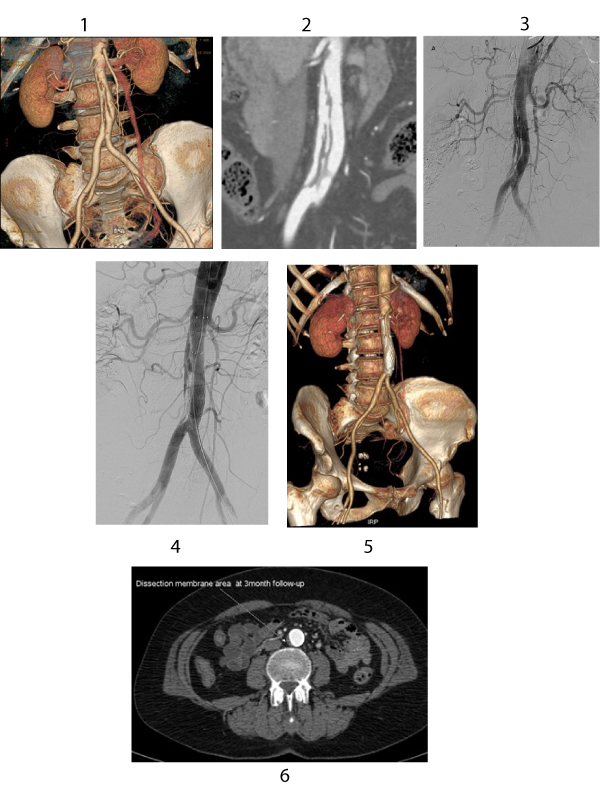 Endovascular Treatment of Focally Dissected Infrarenal Abdominal Aorta with Self-expandable Closed Cell Design Bare Metal Stents