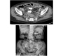 Concomitant Emphysematous Pyelonephritis and Ureteritis