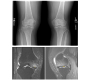 Spontaneous Osteonecrosis as a Cause of Knee Pain in an Older Active Woman