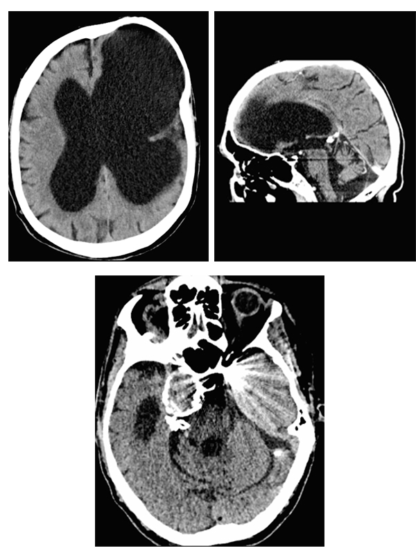 Severe Traumatic Brain Injury (TBI) with Late Cognitive and Functional Decline