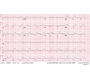 EKG Changes in Severe Hyperkalemia in Digoxin Toxicity