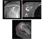 Synovial Osteochondromatosis of Shoulder