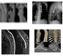 Atypical Fracture Dislocation of Thoracic Vertebra in a Young Men