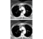 An Uncommon Cause of Dyspnea