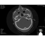 Bilateral Temporal Bone Fractures Associated With Bilateral Profound Sensorineural Hearing Loss