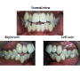 Anterior Open Bite With Sever Crowding Upper and Lower Anterior Segments