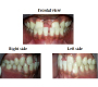 Upper Mid Line Diastema with Bilateral Congenitally Missing Upper Lateral Incisors