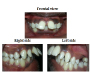 Proclined Upper Central Incisors with Bilateral Beg Shaped Upper Lateral Incisors