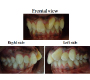 Supernummary Tooth between Upper Central Incisors with 90 Degree Rotation Upper Left Incisors