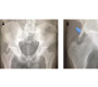 An Asymptomatic Femoroacetabular Impingement: Incidental Finding after Car Crash