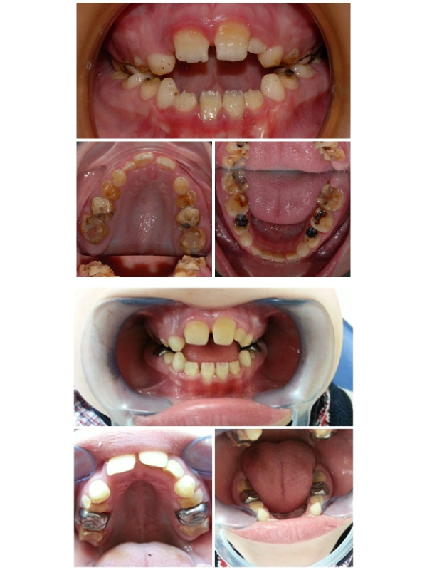 Amelogenesis Imperfecta: A Developmental Dental Anomaly